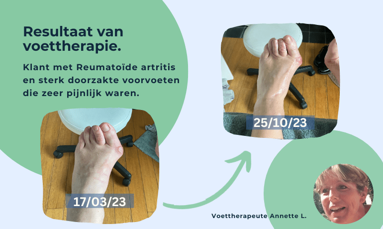 Een Wonderlijk Resultaat na 7 maanden 'Voettherapie'.